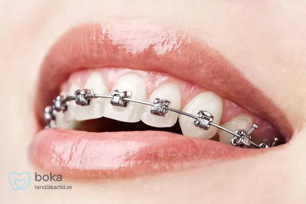 Implantat vs tandbro